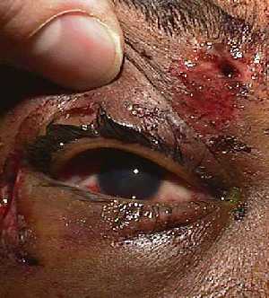 Blunt Orbital Trauma leading to zygoma, orbital floor fracture and intraocular wood.